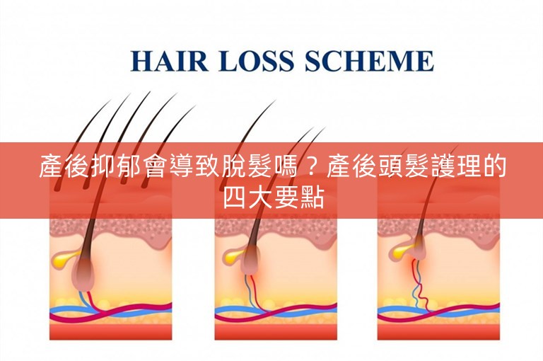 產後抑郁會導致脫髮嗎？產後頭髮護理的四大要點