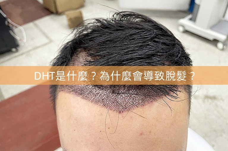 DHT是什麼？為什麼會導致脫髮？