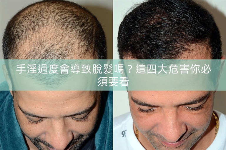 手淫過度會導致脫髮嗎？這四大危害你必須要看