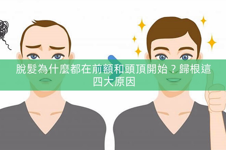 脫髮為什麼都在前額和頭頂開始？歸根這四大原因