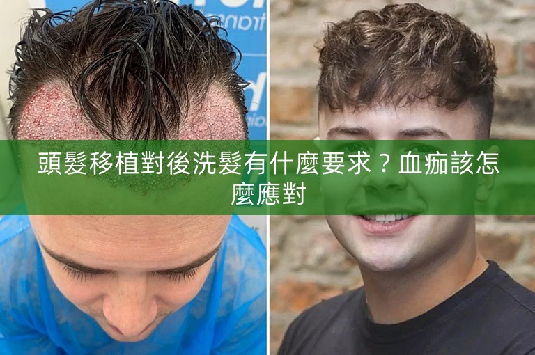 頭髮移植對後洗髮有什麼要求？血痂該怎麼應對