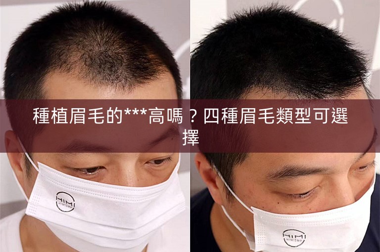 種植眉毛的***高嗎？四種眉毛類型可選擇