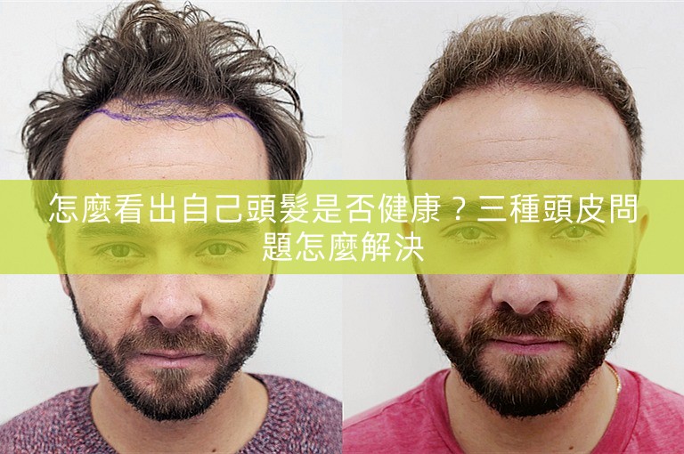 怎麼看出自己頭髮是否健康？三種頭皮問題怎麼解決