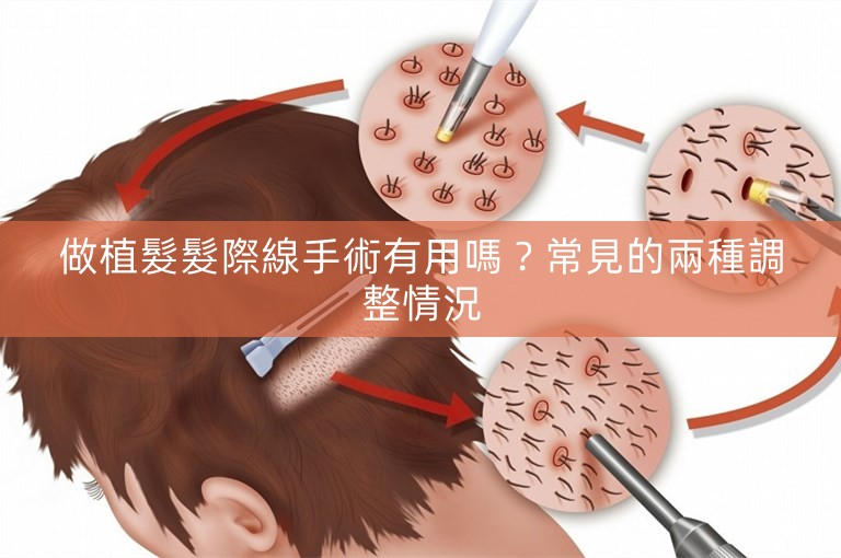 做植髮髮際線手術有用嗎？常見的兩種調整情況