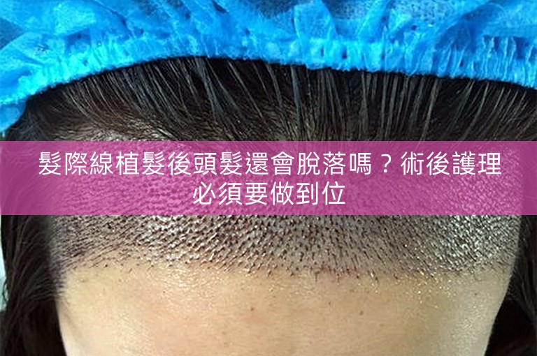 髮際線植髮後頭髮還會脫落嗎？術後護理必須要做到位