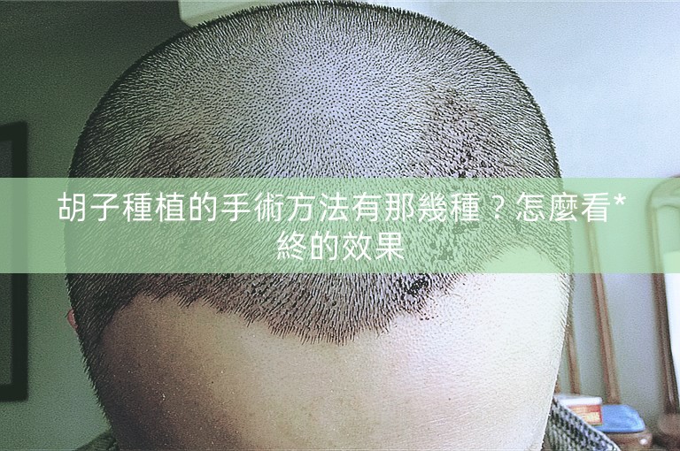 胡子種植的手術方法有那幾種?怎麼看*終的效果 胡子種植的手術方法有那幾種?怎麼看*終的效果