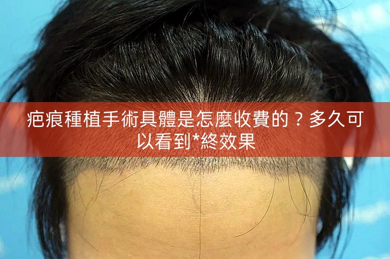 疤痕種植手術具體是怎麼收費的？多久可以看到*終效果
