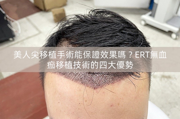 美人尖移植手術能保證效果嗎？ERT無血痂移植技術的四大優勢