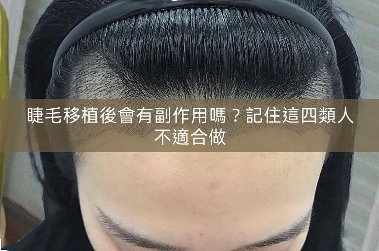 睫毛移植後會有副作用嗎？記住這四類人不適合做