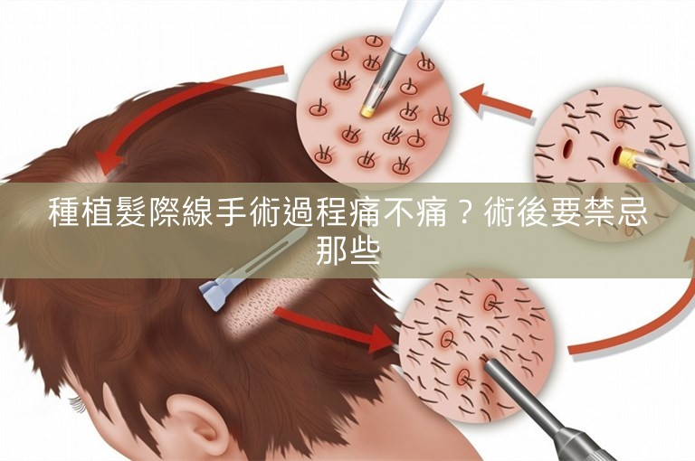 種植髮際線手術過程痛不痛？術後要禁忌那些