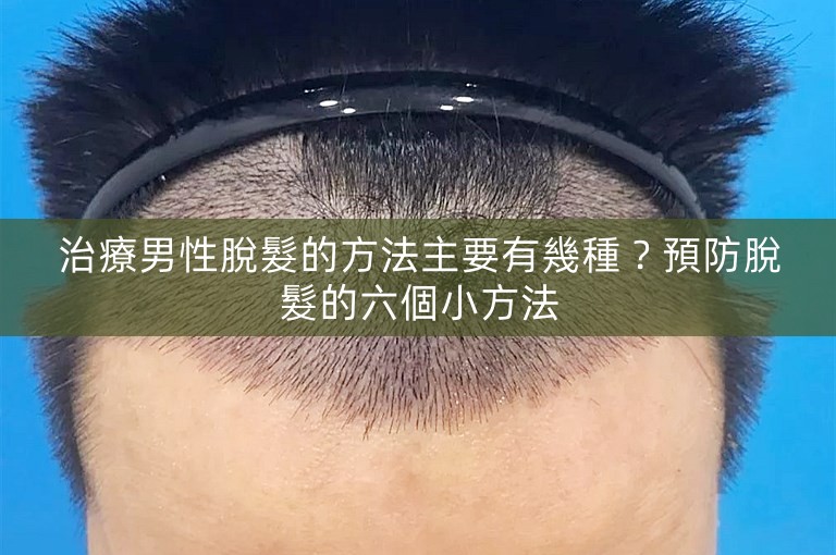 治療男性脫髮的方法主要有幾種？預防脫髮的六個小方法