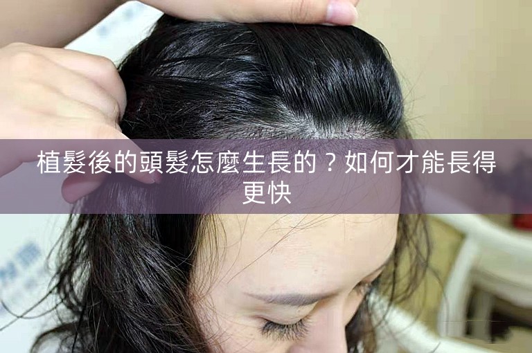 植髮後的頭髮怎麼生長的？如何才能長得更快