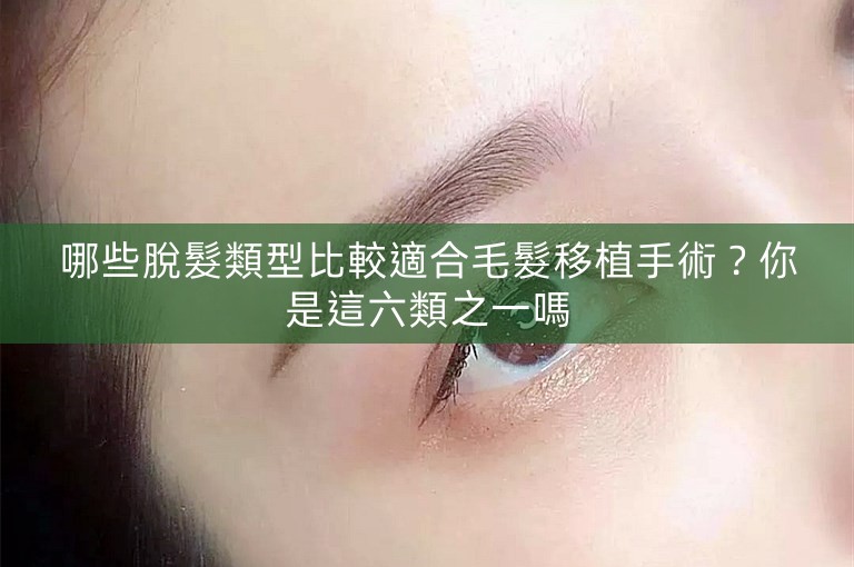 哪些脫髮類型比較適合毛髮移植手術？你是這六類之一嗎