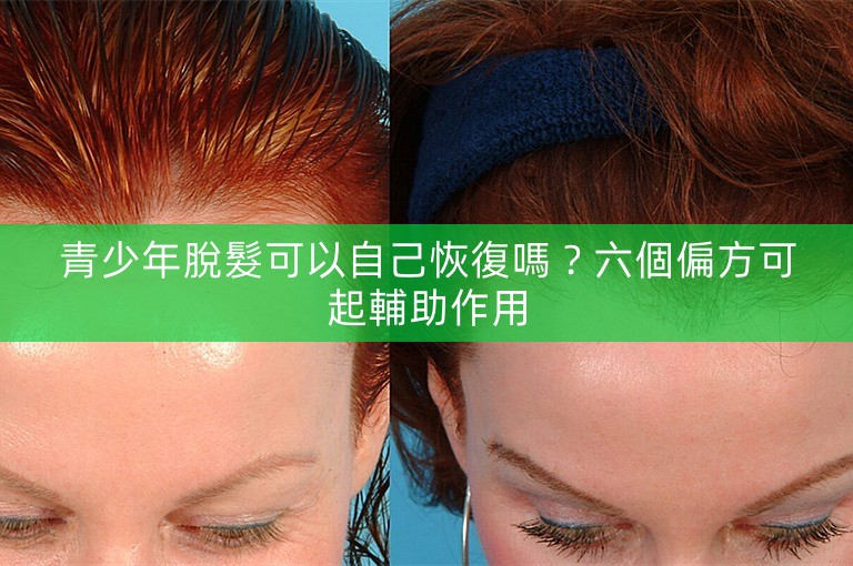 青少年脫髮可以自己恢復嗎？六個偏方可起輔助作用