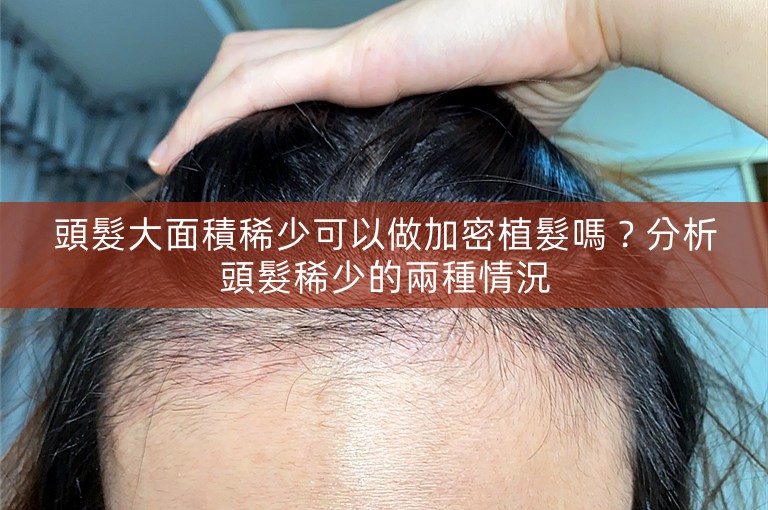 頭髮大面積稀少可以做加密植髮嗎?分析頭髮稀少的兩種情況 頭髮大面積稀少可以做加密植髮嗎?分析頭髮稀少的兩種情況