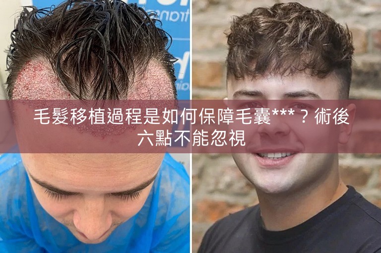 毛髮移植過程是如何保障毛囊***？術後六點不能忽視