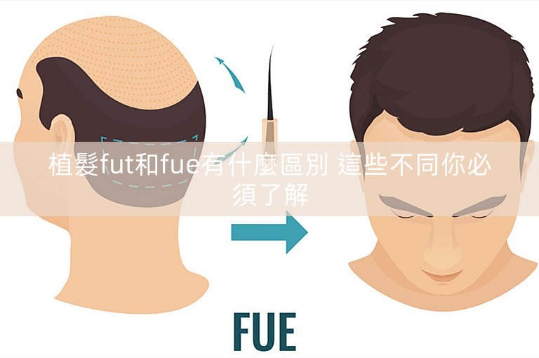 植髮fut和fue有什麼區別 這些不同你必須了解