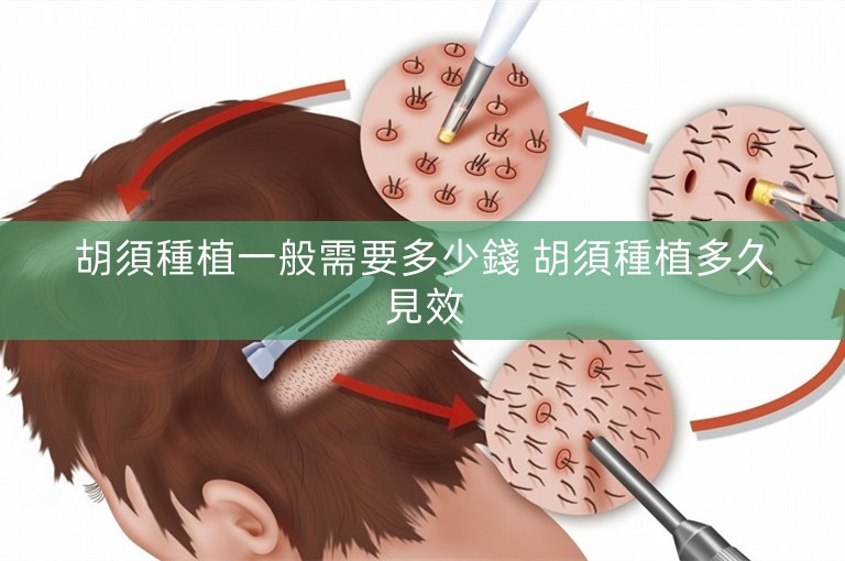 胡須種植一般需要多少錢 胡須種植多久見效