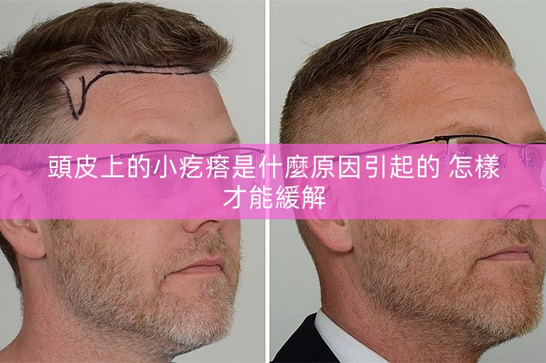頭皮上的小疙瘩是什麼原因引起的 怎樣才能緩解