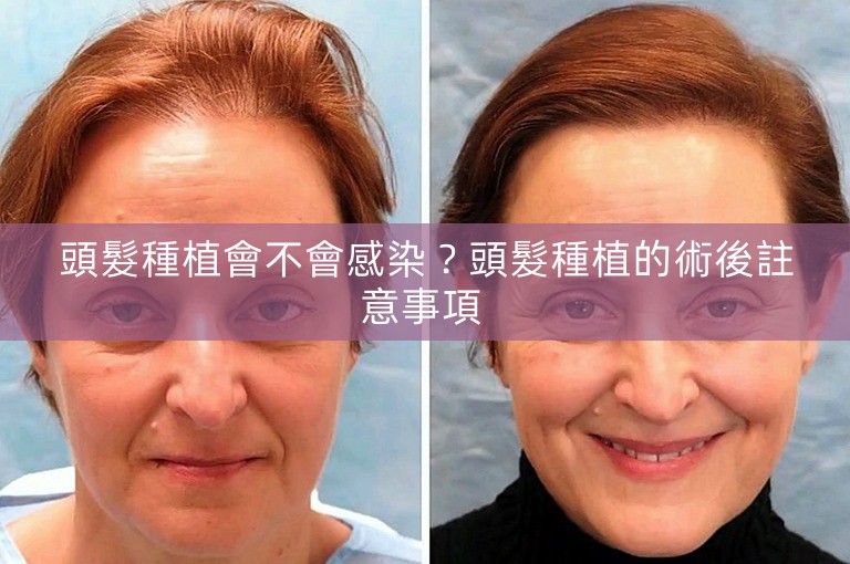 頭髮種植會不會感染？頭髮種植的術後註意事項 