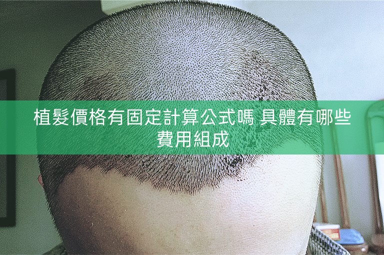 植髮價格有固定計算公式嗎 具體有哪些費用組成
