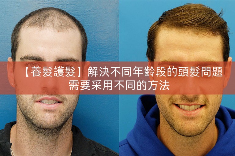 【養髮護髮】解決不同年齡段的頭髮問題 需要采用不同的方法 【養髮護髮】解決不同年齡段的頭髮問題 需要采用不同的方法