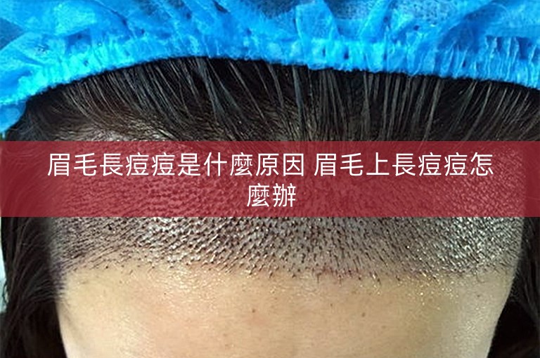 眉毛長痘痘是什麼原因 眉毛上長痘痘怎麼辦