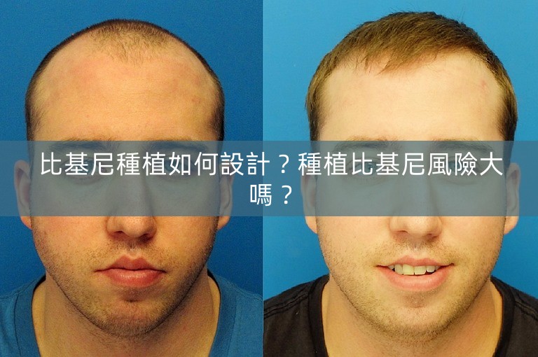 比基尼種植如何設計？種植比基尼風險大嗎？