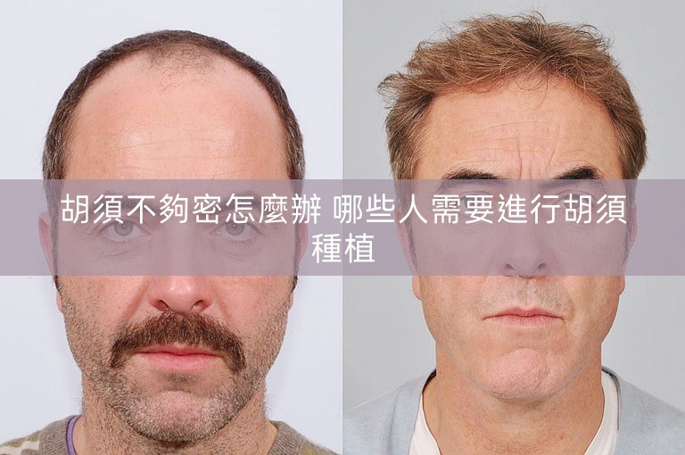 胡須不夠密怎麼辦 哪些人需要進行胡須種植