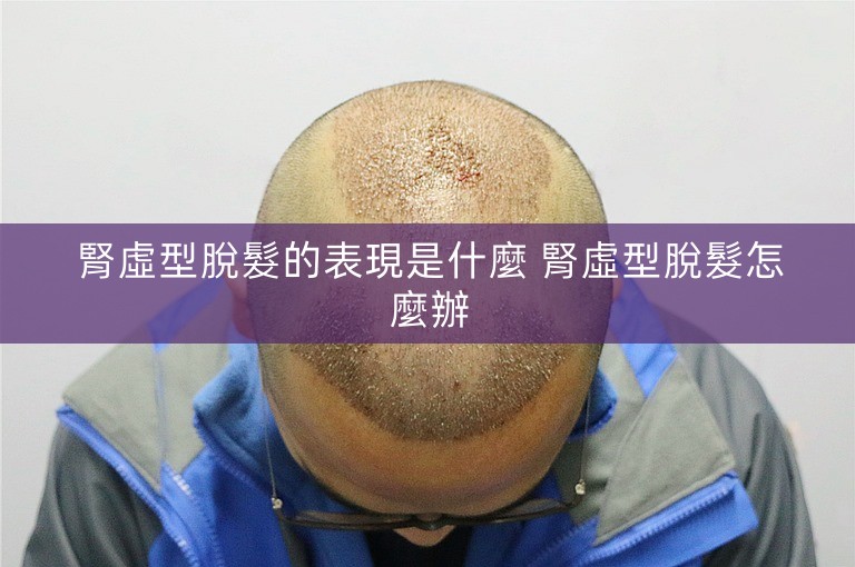 腎虛型脫髮的表現是什麼 腎虛型脫髮怎麼辦 腎虛型脫髮的表現是什麼 腎虛型脫髮怎麼辦