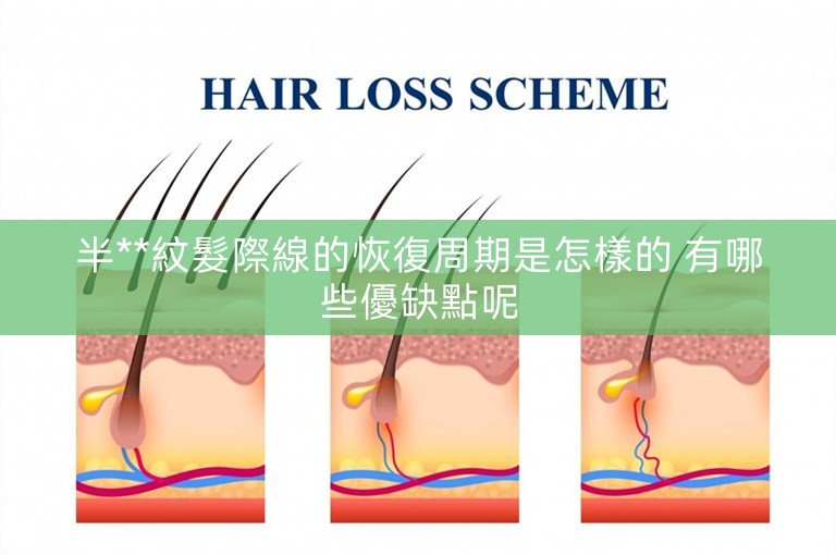 半**紋髮際線的恢復周期是怎樣的 有哪些優缺點呢