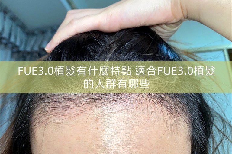 FUE3.0植髮有什麼特點 適合FUE3.0植髮的人群有哪些