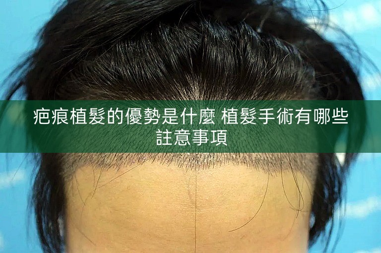疤痕植髮的優勢是什麼 植髮手術有哪些註意事項