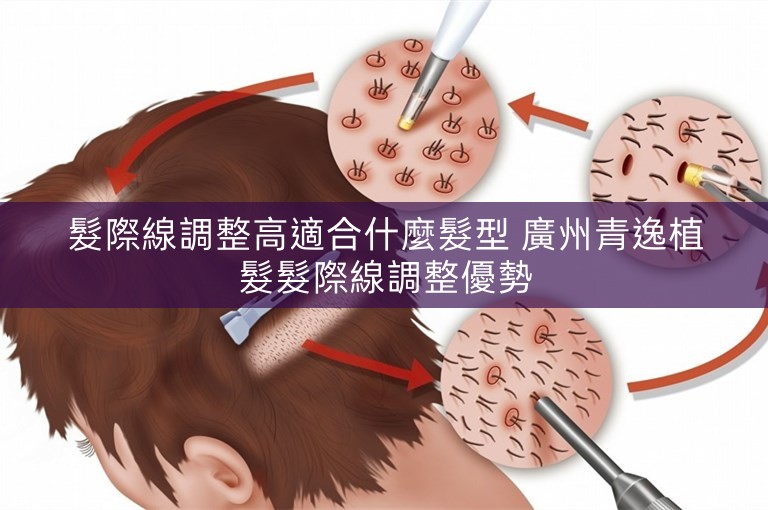 髮際線調整高適合什麼髮型 廣州青逸植髮髮際線調整優勢