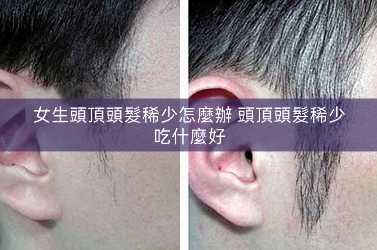 女生頭頂頭髮稀少怎麼辦 頭頂頭髮稀少吃什麼好