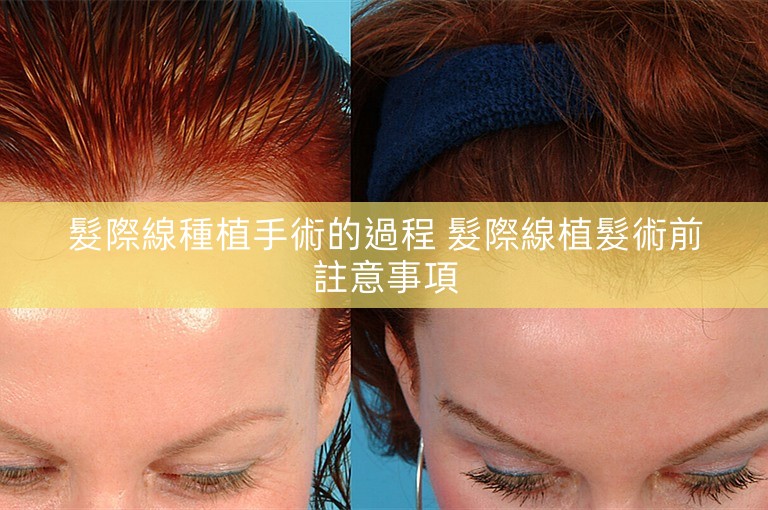 髮際線種植手術的過程 髮際線植髮術前註意事項