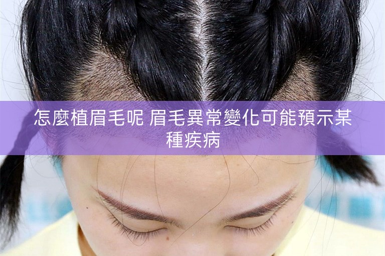 怎麼植眉毛呢 眉毛異常變化可能預示某種疾病