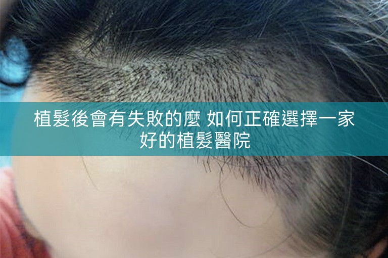 植髮後會有失敗的麼 如何正確選擇一家好的植髮醫院