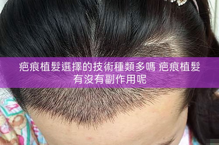 疤痕植髮選擇的技術種類多嗎 疤痕植髮有沒有副作用呢