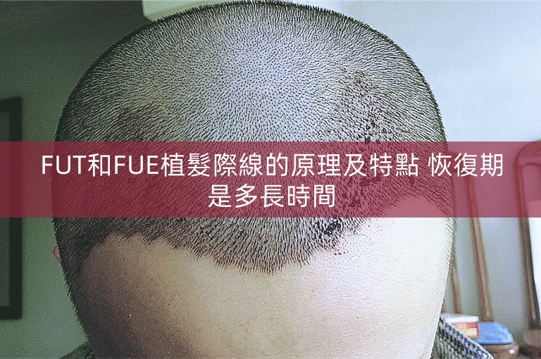 FUT和FUE植髮際線的原理及特點 恢復期是多長時間