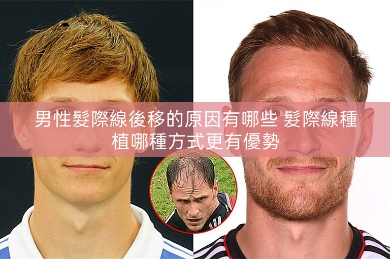 男性髮際線後移的原因有哪些 髮際線種植哪種方式更有優勢