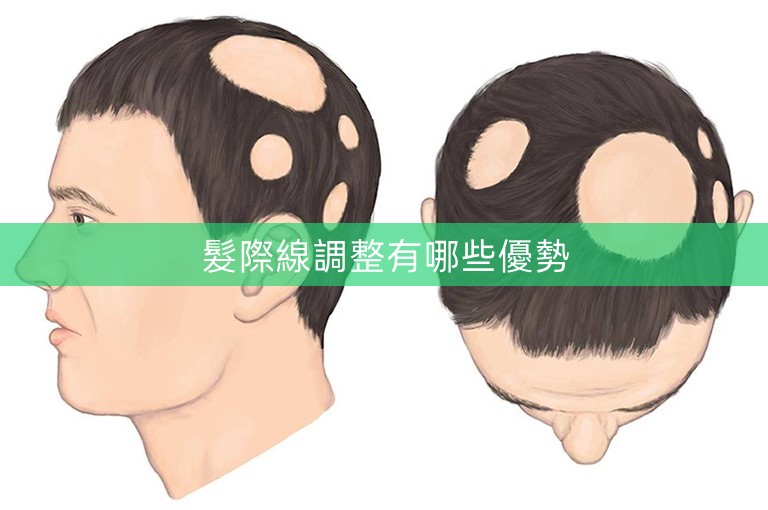 髮際線調整有哪些優勢