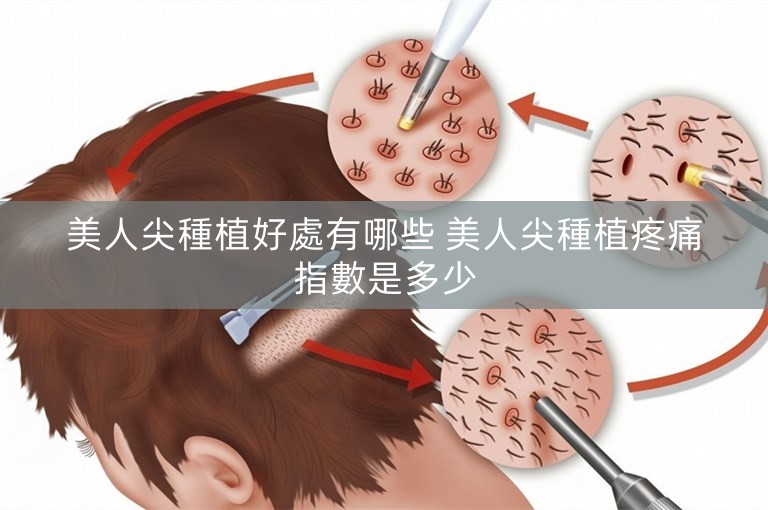 美人尖種植好處有哪些 美人尖種植疼痛指數是多少