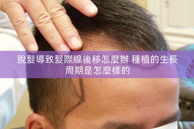 脫髮導致髮際線後移怎麼辦 種植的生長周期是怎麼樣的