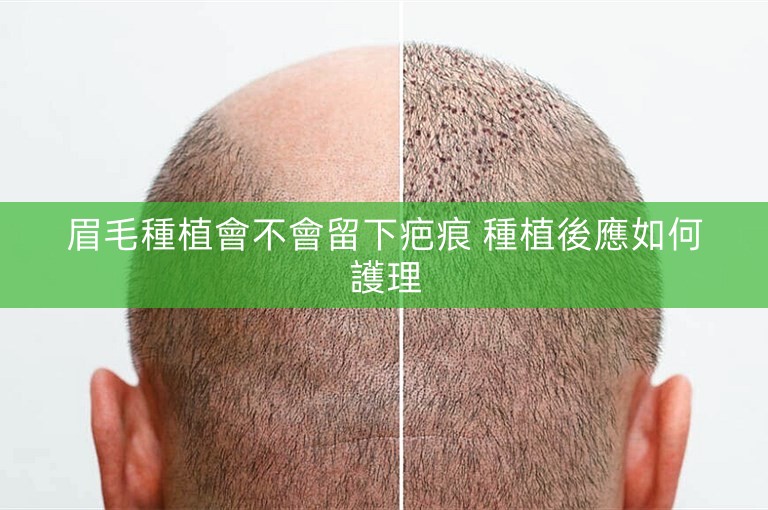 眉毛種植會不會留下疤痕 種植後應如何護理