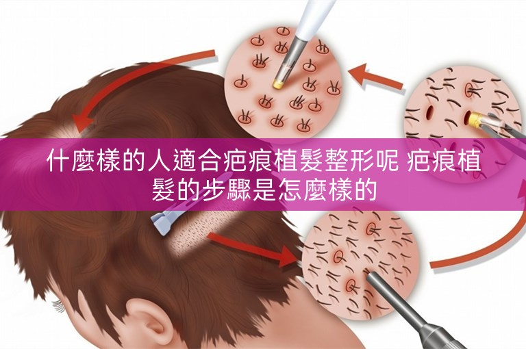 什麼樣的人適合疤痕植髮整形呢 疤痕植髮的步驟是怎麼樣的