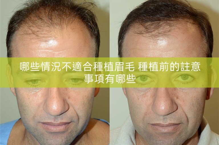 哪些情況不適合種植眉毛 種植前的註意事項有哪些