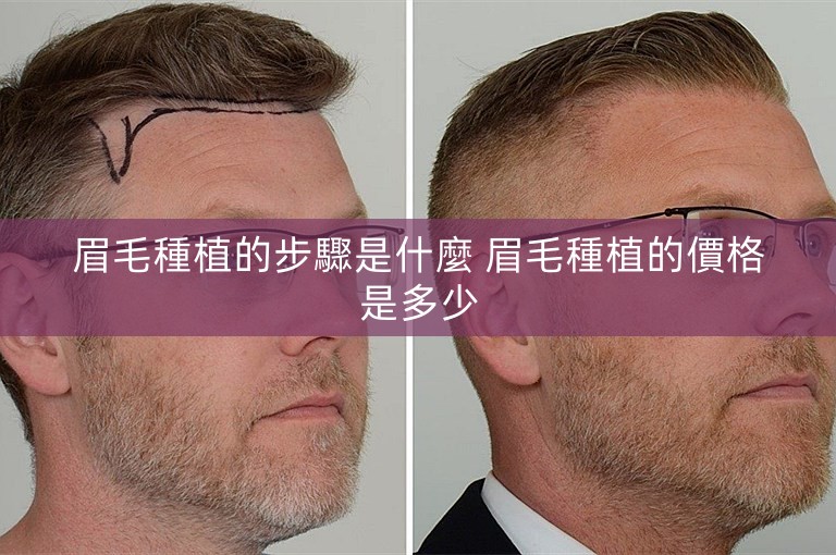 眉毛種植的步驟是什麼 眉毛種植的價格是多少