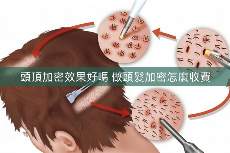 頭頂加密效果好嗎 做頭髮加密怎麼收費