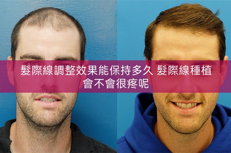 髮際線調整效果能保持多久 髮際線種植會不會很疼呢 髮際線調整效果能保持多久 髮際線種植會不會很疼呢